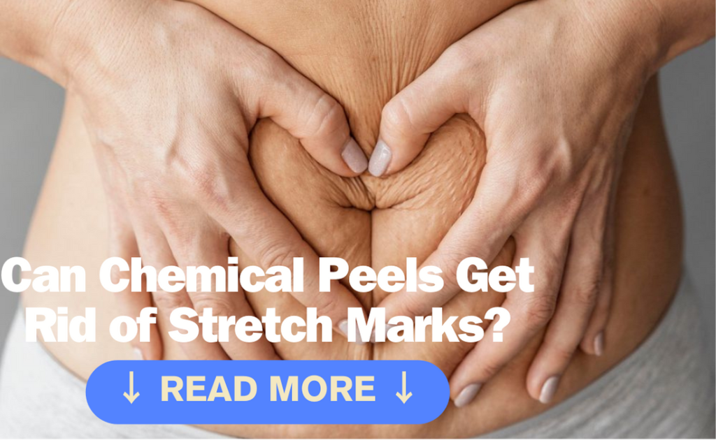 can-chemical-peels-get-rid-of-stretch-marks-chemical-peeling