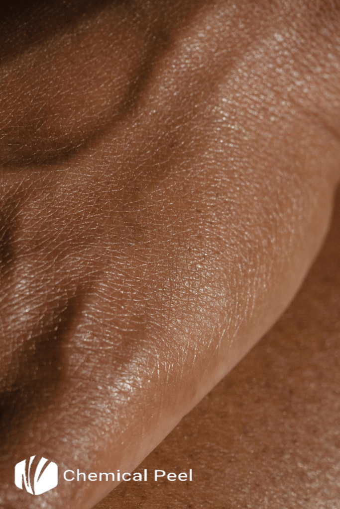 From Melanin to Luminescence Exploring Chemical Peeling's Impact on Darker Complexions